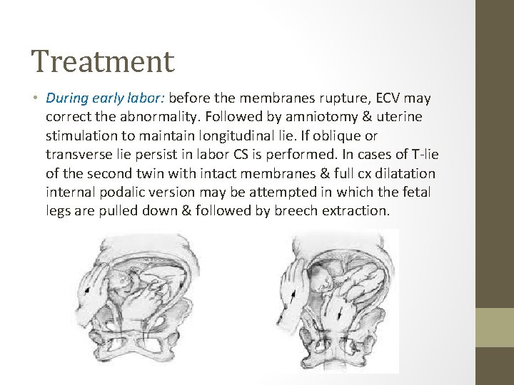 Treatment • During early labor: before the membranes rupture, ECV may correct the abnormality.