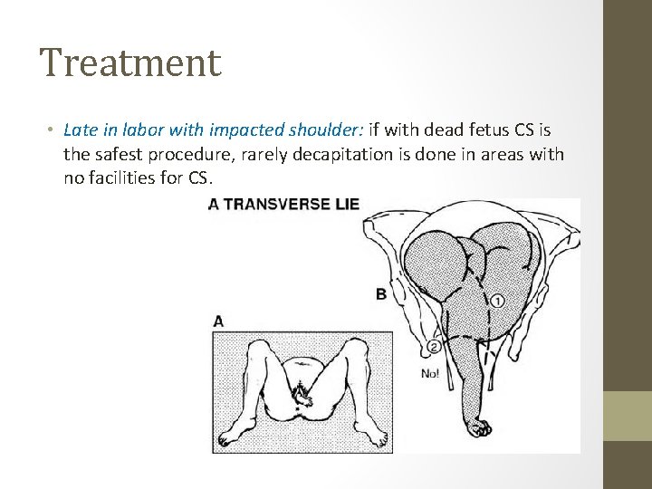 Treatment • Late in labor with impacted shoulder: if with dead fetus CS is