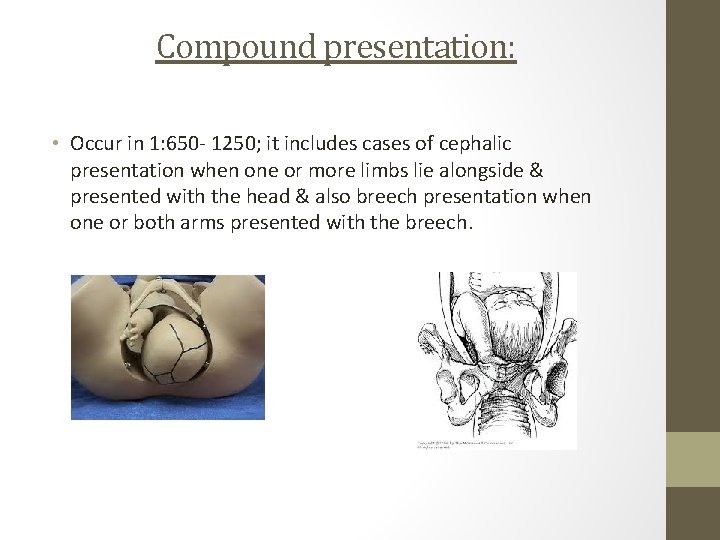 Compound presentation: • Occur in 1: 650 - 1250; it includes cases of cephalic