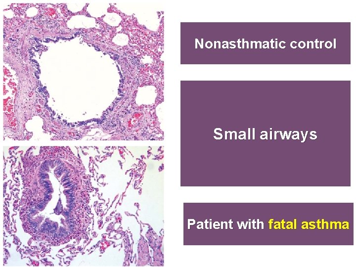 19 Nonasthmatic control Small airways Patient with fatal asthma 