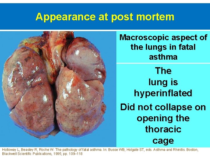Appearance at post mortem Macroscopic aspect of the lungs in fatal asthma The lung