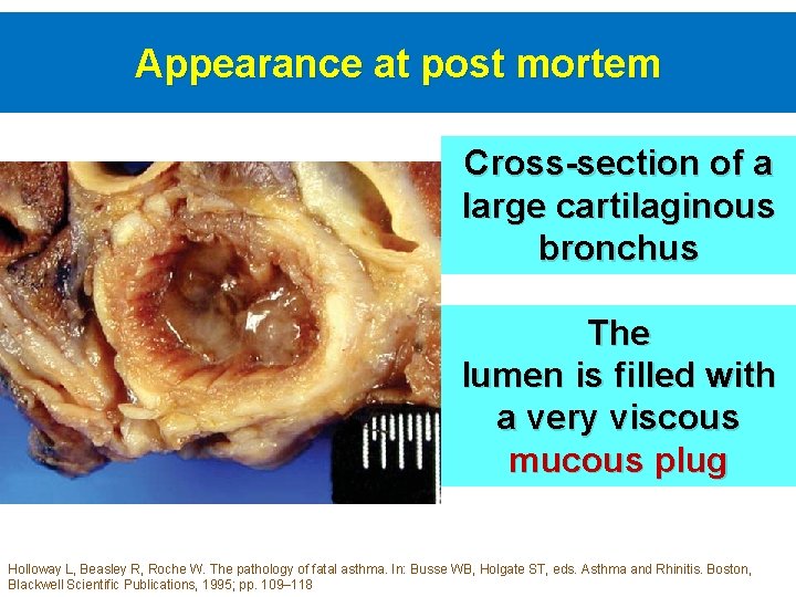 Appearance at post mortem Cross-section of a large cartilaginous bronchus The lumen is filled