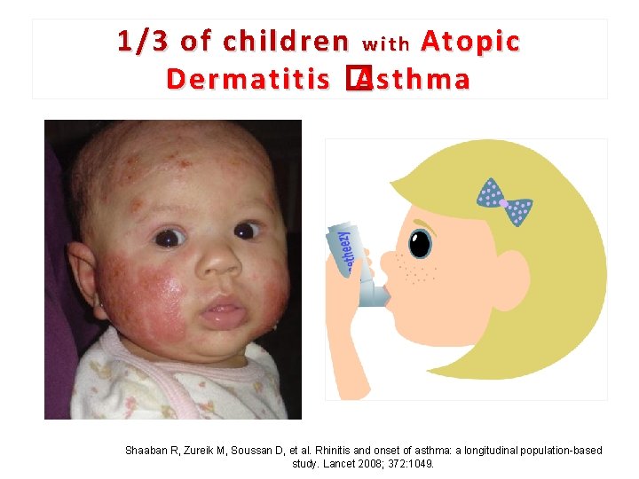 1/3 of children w i t h Atopic Dermatitis � Asthma 49 Shaaban R,
