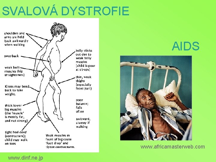 SVALOVÁ DYSTROFIE AIDS www. africamasterweb. com www. dinf. ne. jp 