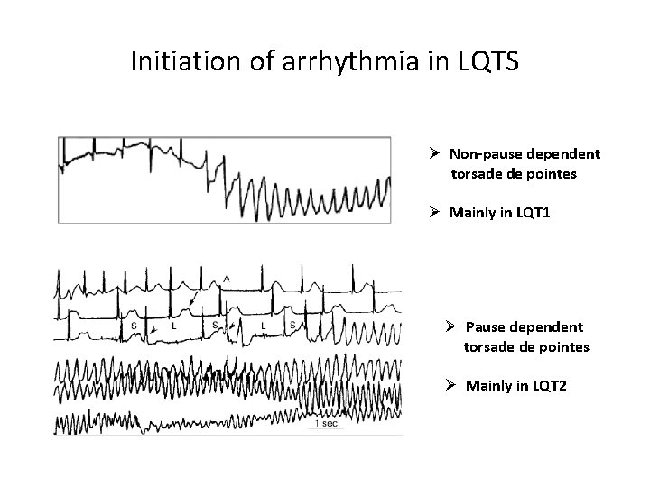 Initiation of arrhythmia in LQTS Ø Non-pause dependent torsade de pointes Ø Mainly in