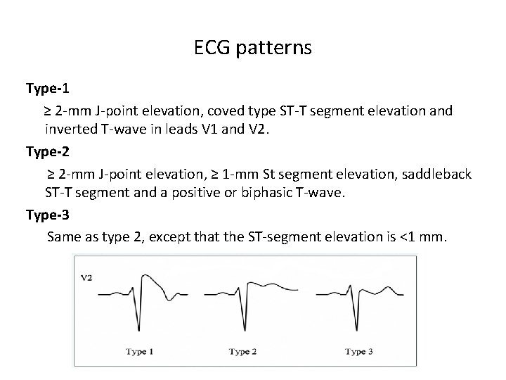 ECG patterns Type-1 ≥ 2 -mm J-point elevation, coved type ST-T segment elevation and