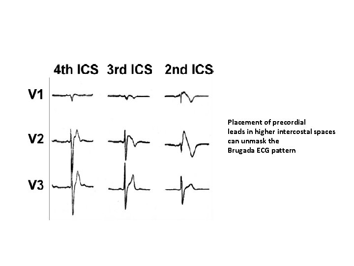 Placement of precordial leads in higher intercostal spaces can unmask the Brugada ECG pattern