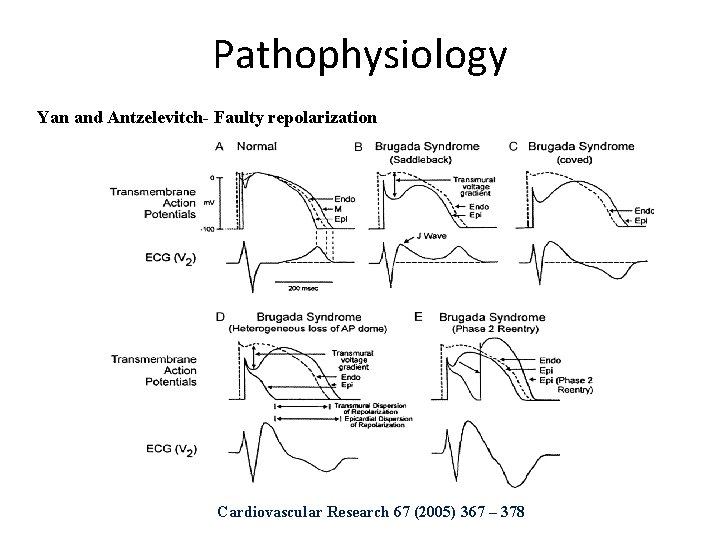 Pathophysiology Yan and Antzelevitch- Faulty repolarization Cardiovascular Research 67 (2005) 367 – 378 