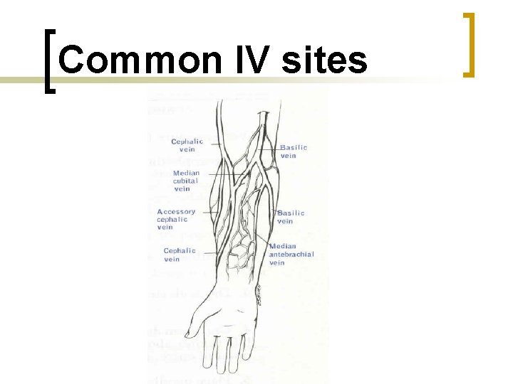 Common IV sites 
