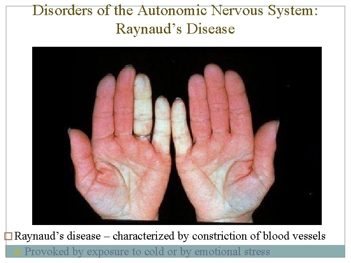 Disorders of the Autonomic Nervous System: Raynaud’s Disease � Raynaud’s disease – characterized by