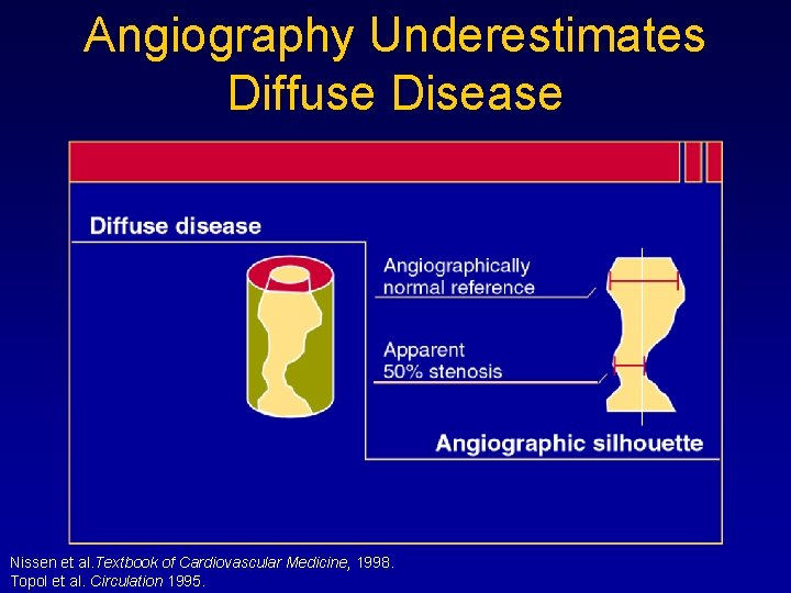 Angiography Underestimates Diffuse Disease Nissen et al. Textbook of Cardiovascular Medicine, 1998. Topol et