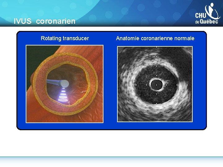  IVUS coronarien Rotating transducer Anatomie coronarienne normale Images courtesy of Cleveland Clinic Intravascular