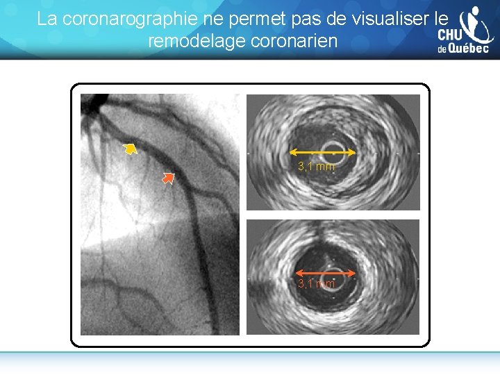 La coronarographie ne permet pas de visualiser le remodelage coronarien 3, 1 mm 