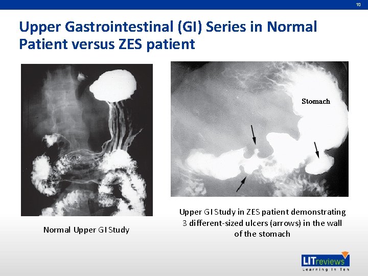 10 Upper Gastrointestinal (GI) Series in Normal Patient versus ZES patient Normal Upper GI