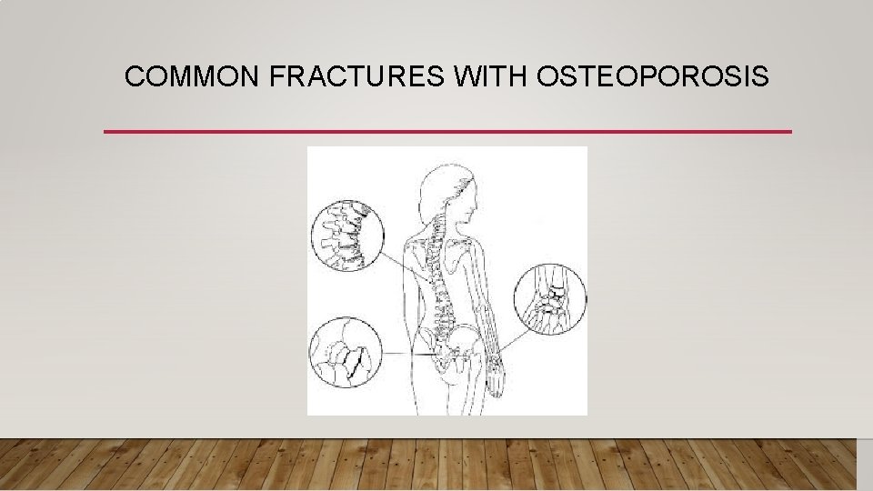 COMMON FRACTURES WITH OSTEOPOROSIS 