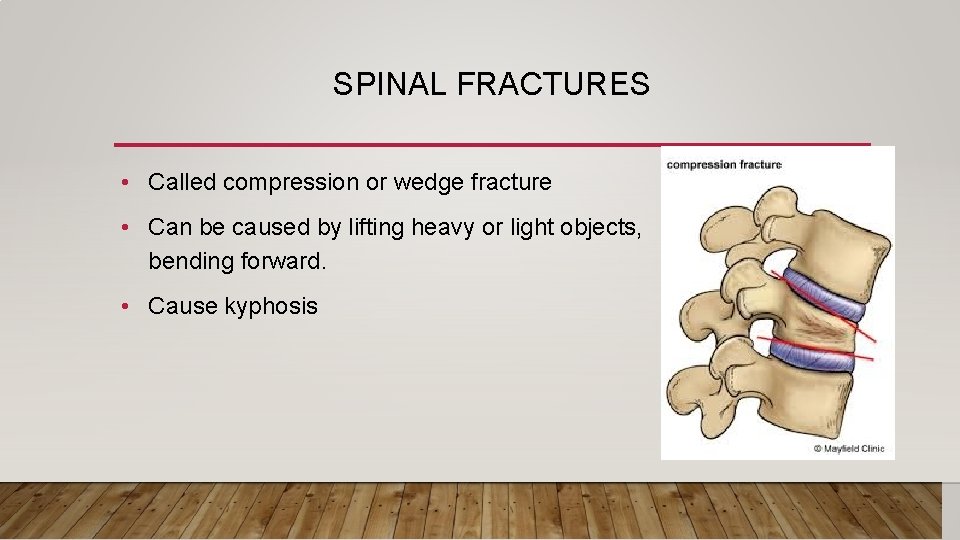 SPINAL FRACTURES • Called compression or wedge fracture • Can be caused by lifting