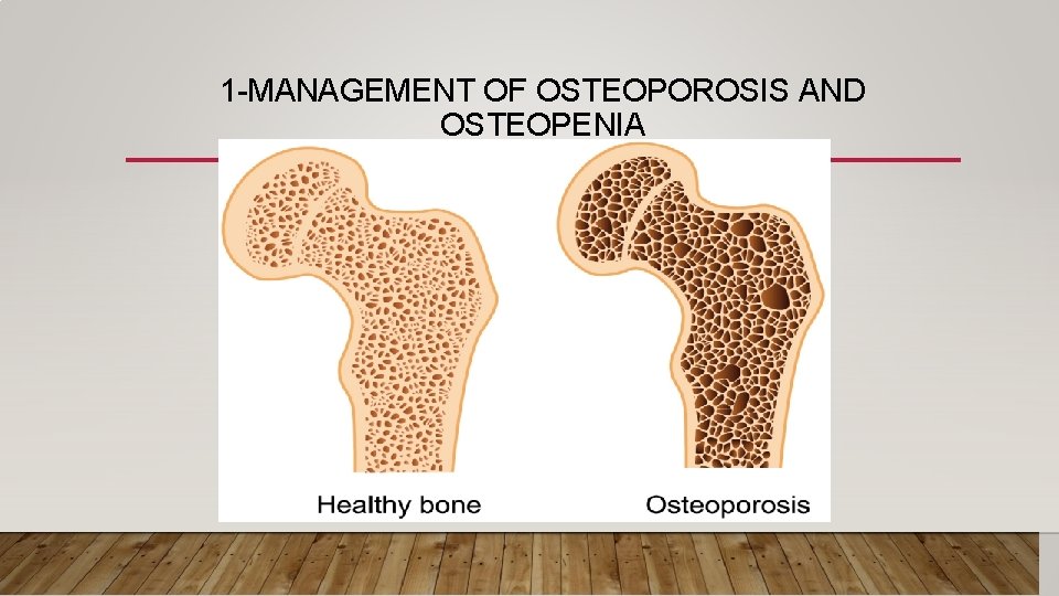 1 -MANAGEMENT OF OSTEOPOROSIS AND OSTEOPENIA 