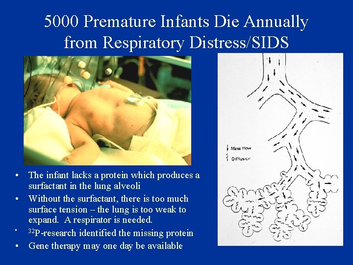 5000 Premature Infants Die Annually from Respiratory Distress/SIDS • The infant lacks a protein