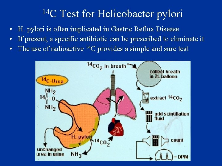14 C Test for Helicobacter pylori • H. pylori is often implicated in Gastric
