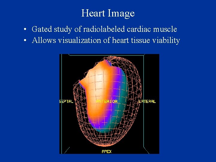 Heart Image • Gated study of radiolabeled cardiac muscle • Allows visualization of heart