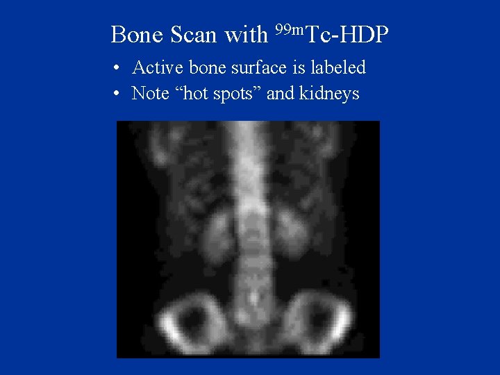 Bone Scan with 99 m. Tc-HDP • Active bone surface is labeled • Note