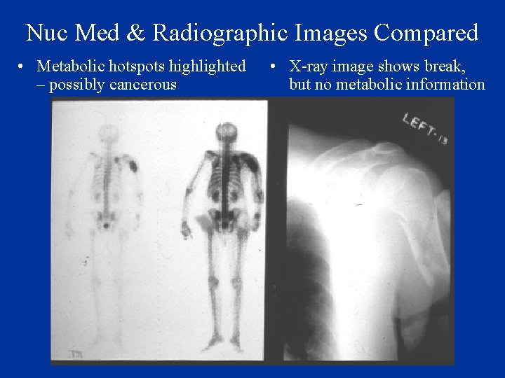 Nuc Med & Radiographic Images Compared • Metabolic hotspots highlighted – possibly cancerous •