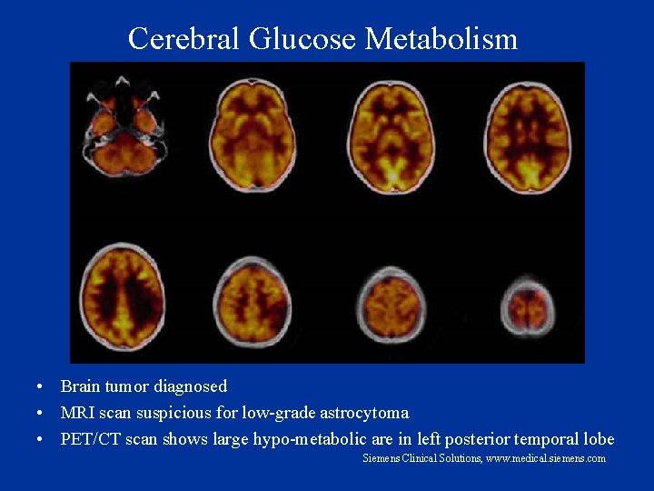 Cerebral Glucose Metabolism • Brain tumor diagnosed • MRI scan suspicious for low-grade astrocytoma