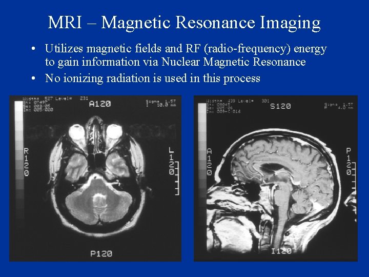 MRI – Magnetic Resonance Imaging • Utilizes magnetic fields and RF (radio-frequency) energy to