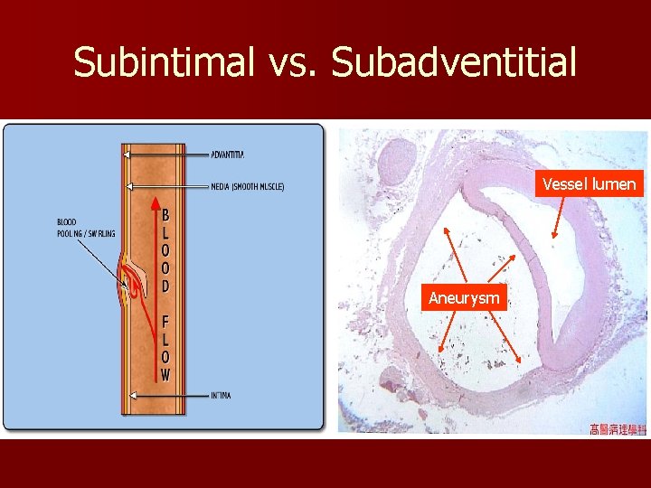 Subintimal vs. Subadventitial Vessel lumen Aneurysm 