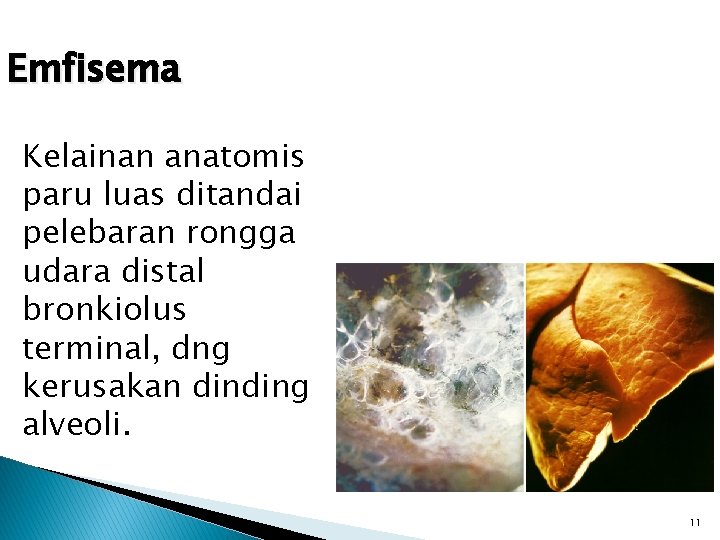 Emfisema Kelainan anatomis paru luas ditandai pelebaran rongga udara distal bronkiolus terminal, dng kerusakan