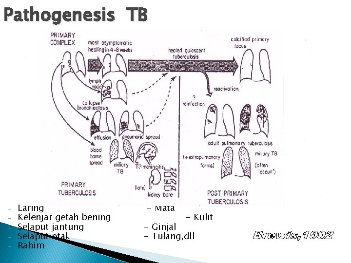 Pathogenesis TB - Laring Kelenjar getah bening Selaput jantung Selaput otak Rahim - Mata