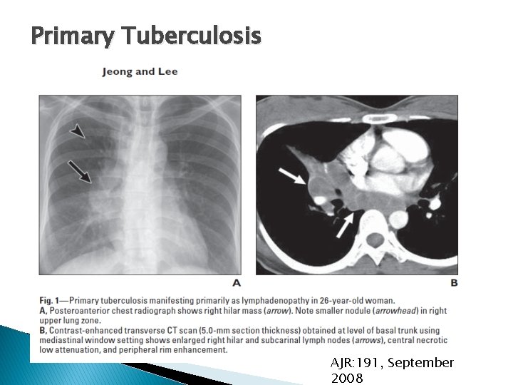 Primary Tuberculosis AJR: 191, September 2008 