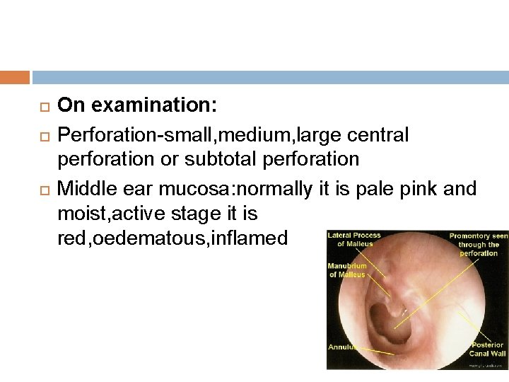  On examination: Perforation-small, medium, large central perforation or subtotal perforation Middle ear mucosa: