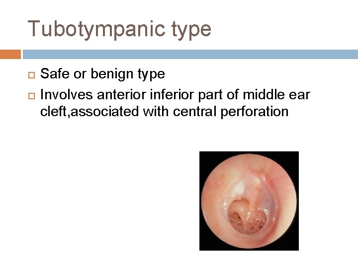 Tubotympanic type Safe or benign type Involves anterior inferior part of middle ear cleft,