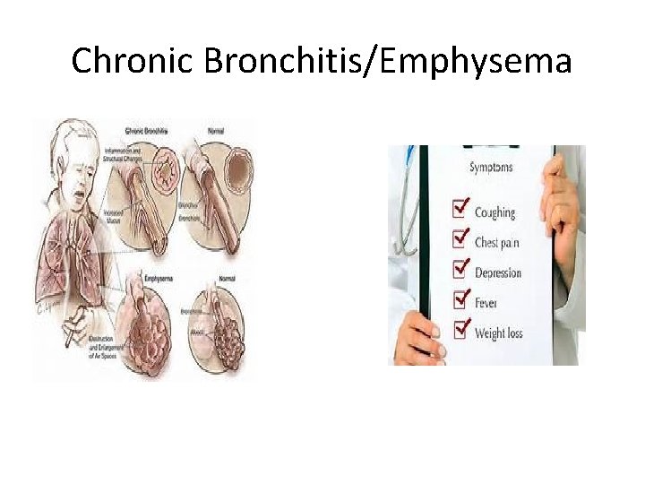 Chronic Bronchitis/Emphysema 