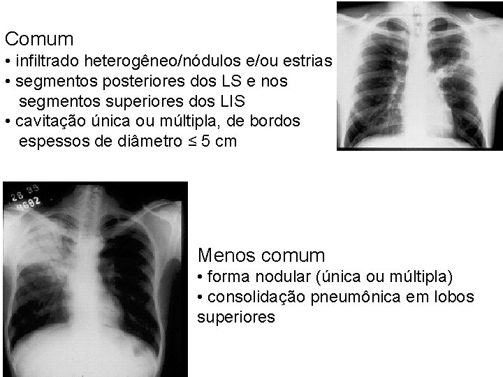 Comum • infiltrado heterogêneo/nódulos e/ou estrias • segmentos posteriores dos LS e nos segmentos