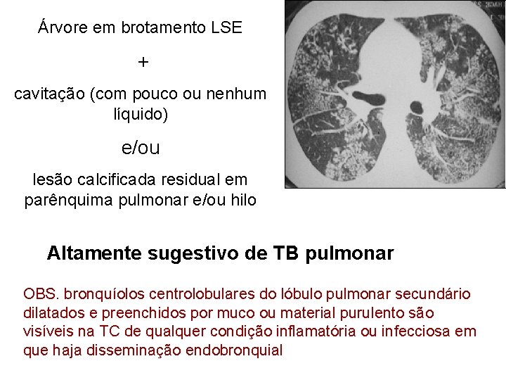 Árvore em brotamento LSE + cavitação (com pouco ou nenhum líquido) e/ou lesão calcificada