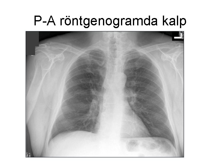P-A röntgenogramda kalp P-A röntgenogramda kalp