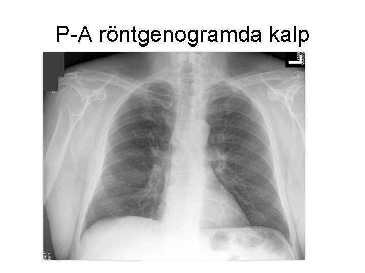 P-A röntgenogramda kalp 