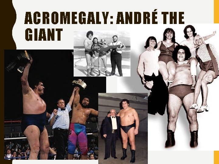 ACROMEGALY: ANDRÉ THE GIANT 