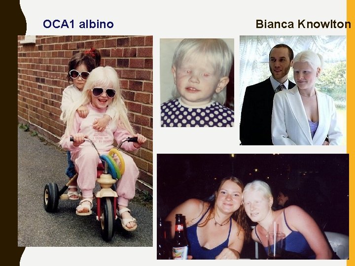 OCA 1 albino Bianca Knowlton 