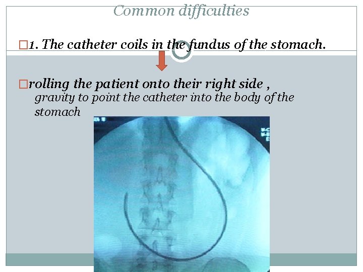 Common difficulties � 1. The catheter coils in the fundus of the stomach. �rolling