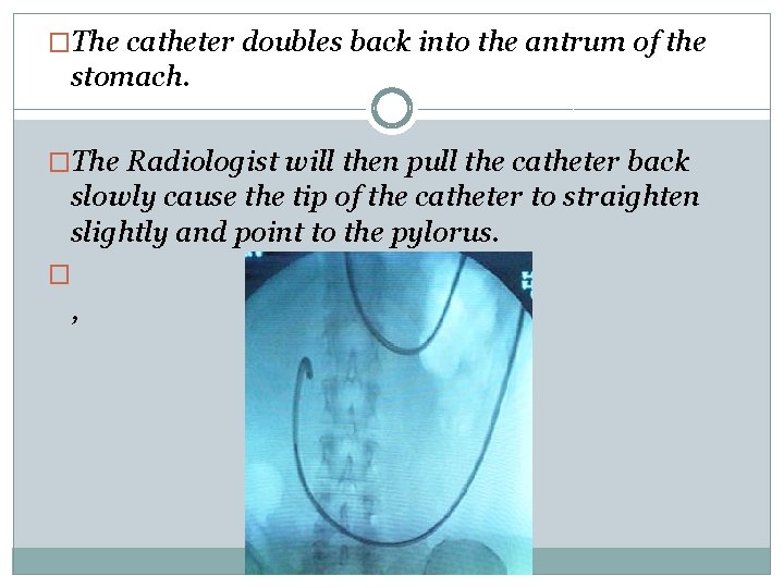 �The catheter doubles back into the antrum of the stomach. �The Radiologist will then