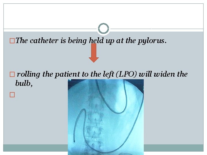 �The catheter is being held up at the pylorus. � rolling the patient to