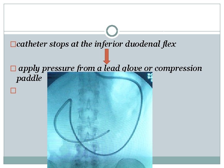 �catheter stops at the inferior duodenal flex � apply pressure from a lead glove