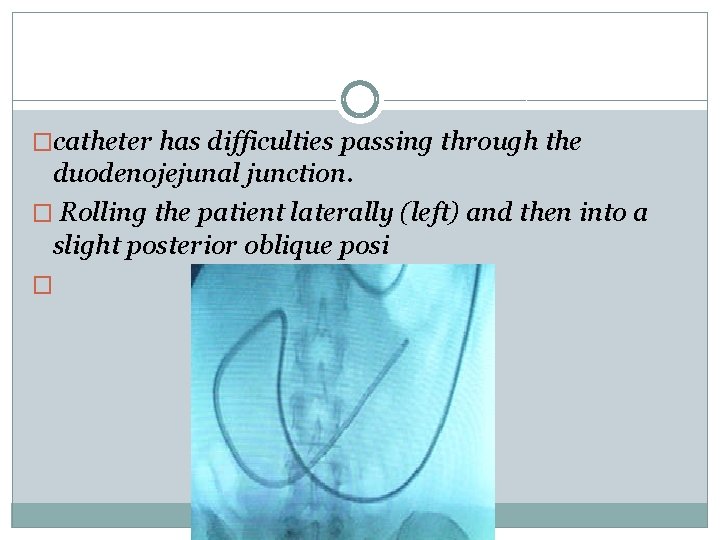 �catheter has difficulties passing through the duodenojejunal junction. � Rolling the patient laterally (left)