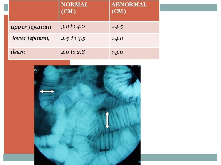 NORMAL (CM) ABNORMAL (CM) upper jejunum 3. 0 to 4. 0 >4. 5 lower