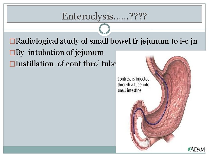 Enteroclysis……? ? �Radiological study of small bowel fr jejunum to i-c jn �By intubation