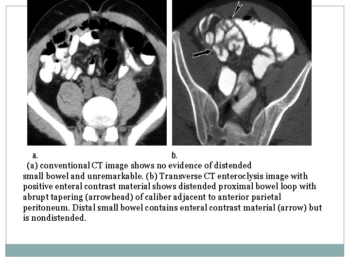 (a) conventional CT image shows no evidence of distended small bowel and unremarkable. (b)