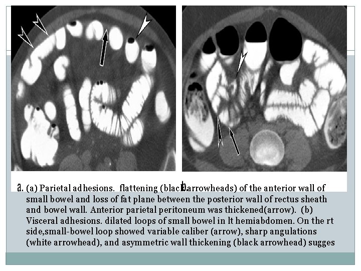 (a) Parietal adhesions. flattening (black arrowheads) of the anterior wall of small bowel and